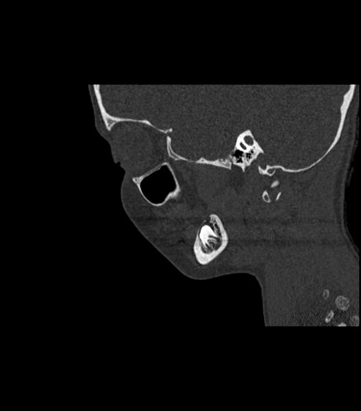 File:Nasoorbitoethmoid fracture (Radiopaedia 90044-107205 Sagittal bone window 45).jpg