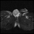 Necrotizing epididymo-orchitis with intra-testicular abscess (Radiopaedia 29397-29860 Axial T2 fat sat 12).jpg