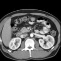 Necrotizing pancreatitis with acute necrotic collection (Radiopaedia 14470-14417 B 17).jpg