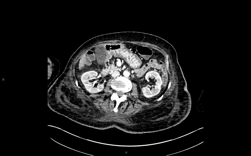 Neo-terminal ileal stricture (Crohn disease) (Radiopaedia 33790-34948 A 181).jpg
