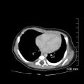 Neonatal neuroblastoma (Radiopaedia 56651-63438 Axial non-contrast 6).jpg