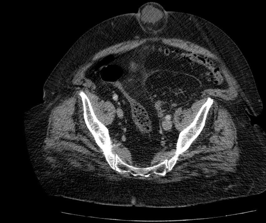 Nephroptosis with inguinal hernia containing perirenal fat (Radiopaedia 56632-63391 C 281).jpg