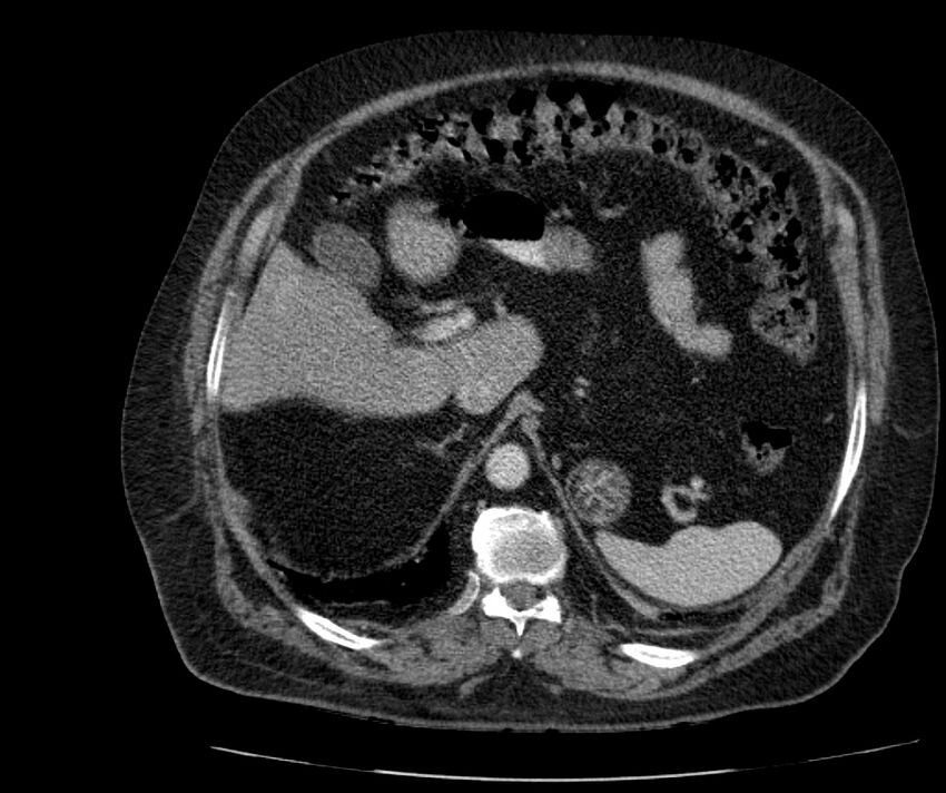 Nephroptosis with inguinal hernia containing perirenal fat (Radiopaedia 56632-63391 C 94).jpg