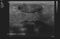 Neurofibromatosis of breast (Radiopaedia 5921-7462 J 1).jpg