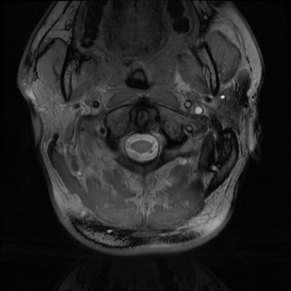 File:Neurofibromatosis type 2 (Radiopaedia 44936-48837 Axial Gradient Echo 46).png