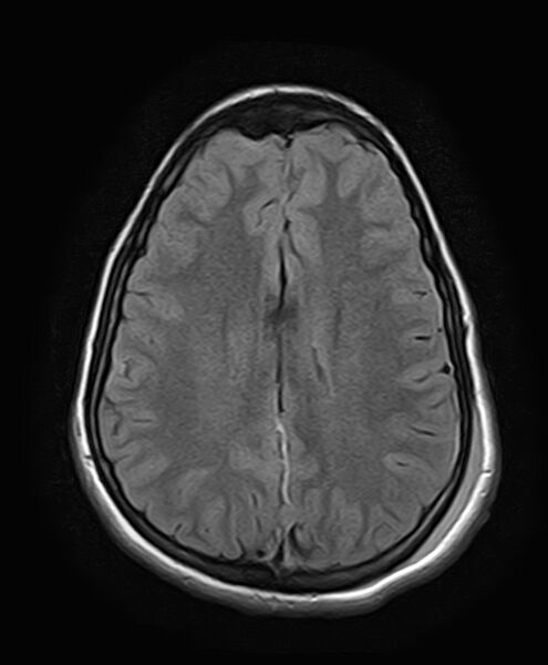 File:Neurofibromatosis type 2 (Radiopaedia 66211-75401 Axial FLAIR 20).jpg