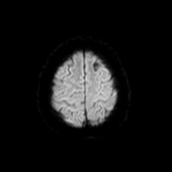 File:Neurofibromatosis type 2 (Radiopaedia 67470-76871 Axial DWI 18).jpg