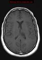 Neuroglial cyst (Radiopaedia 10713-11184 Axial T1 10).jpg