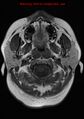 Neuroglial cyst (Radiopaedia 10713-11184 Axial T1 22).jpg