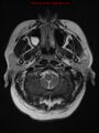 Neuroglial cyst (Radiopaedia 10713-11184 Axial T2 21).jpg