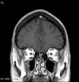 Neurosarcoidosis (Radiopaedia 10930-17204 Coronal T1 C+ 2).jpg