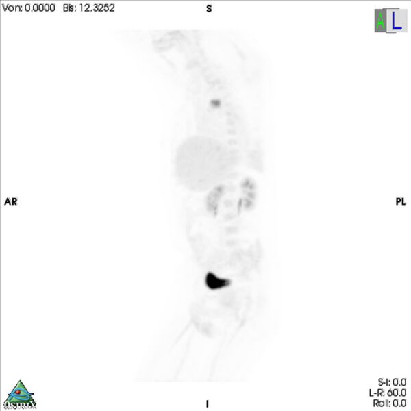 File:Non-Hodgkin lymphoma involving seminal vesicles with development of interstitial pneumonitis during Rituximab therapy (Radiopaedia 32703-33752 PET cor 3D MIP 3).jpg