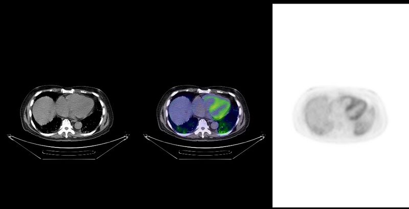 File:Non-Hodgkin lymphoma involving seminal vesicles with development of interstitial pneumonitis during Rituximab therapy (Radiopaedia 32703-33761 ax CT Fus PET 22).jpg