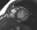 Non-compaction of the left ventricle (Radiopaedia 69436-79314 Short axis cine 114).jpg