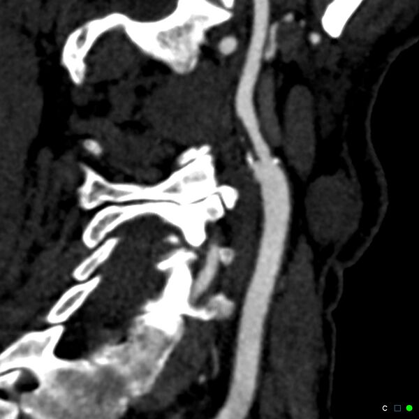 File:Non-occlusive intraluminal internal carotid artery thrombus (Radiopaedia 37751-39658 C 10).jpg
