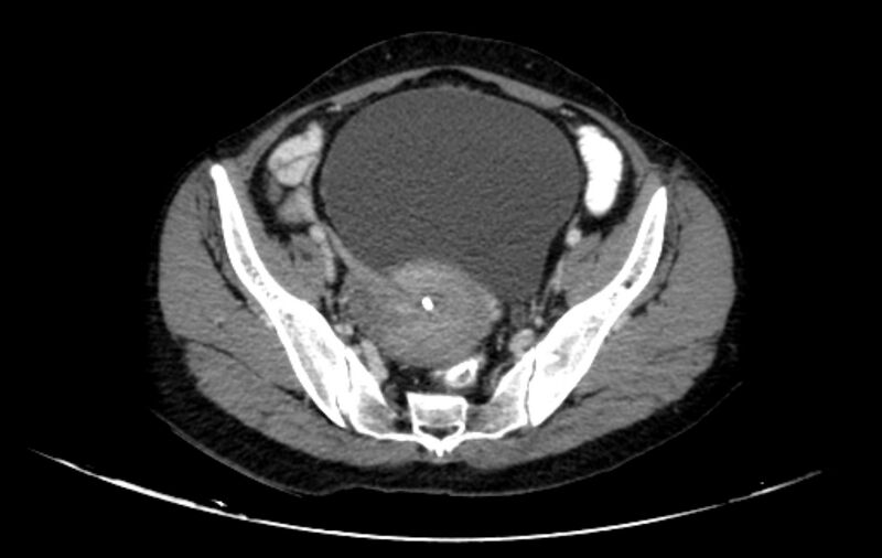 File:Non-puerperal uterine inversion (Radiopaedia 78343-91094 A 7).jpg
