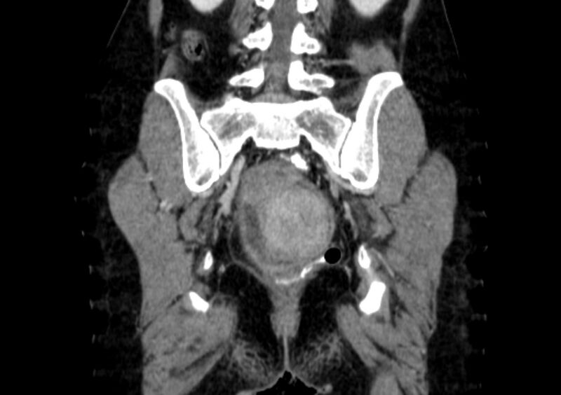 File:Non-puerperal uterine inversion (Radiopaedia 78343-91094 B 45).jpg