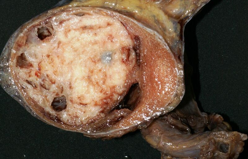 File:Non-seminomatous germ cell tumor (gross pathology) (Radiopaedia 26744).JPG