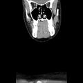 Normal CT of the neck (Radiopaedia 14575-14500 Coronal C+ 13).jpg