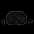 Normal MRI abdomen in pregnancy (Radiopaedia 88001-104541 Axial T2 7).jpg