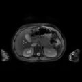 Normal MRI abdomen in pregnancy (Radiopaedia 88001-104541 D 16).jpg