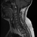 Normal cervical and thoracic spine MRI (Radiopaedia 35630-37156 Sagittal T1 5).png