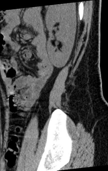 File:Normal lumbar spine CT (Radiopaedia 46533-50986 C 4).png