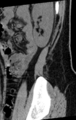 Normal lumbar spine CT (Radiopaedia 46533-50986 C 4).png