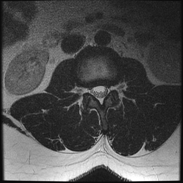 File:Normal lumbar spine MRI (Radiopaedia 43051-46311 Axial T2 8).jpg