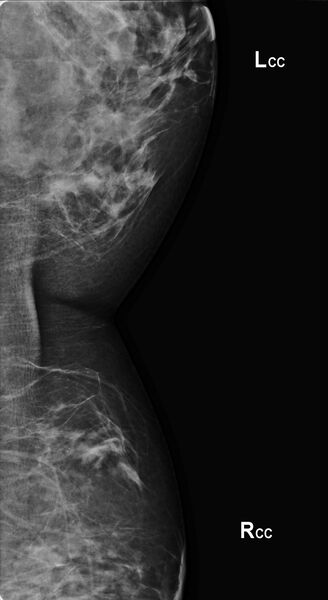 File:Normal mammographic cleavage view (Radiopaedia 25430).jpg