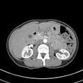 Normal multiphase CT liver (Radiopaedia 38026-39996 B 35).jpg