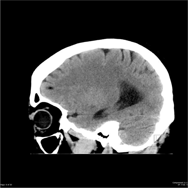 File:Normal pressure hydrocephalus (Radiopaedia 24415-24736 A 8).jpg