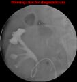 Normal retrograde pyelography of a native and transplant kidney (Radiopaedia 40480-43054 Transplant kidney 9).jpg
