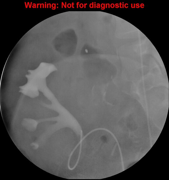 File:Normal retrograde pyelography of a native and transplant kidney (Radiopaedia 40480-43054 Transplant kidney 9).jpg