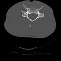 Normal trauma spine imaging (age 16) (Radiopaedia 45335-49358 Axial bone window 52).jpg