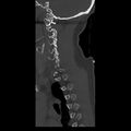 Occipital condyle fracture (Radiopaedia 31755-32691 Sagittal bone window 8).jpg