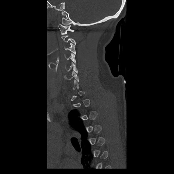 File:Occipital condyle fracture (Radiopaedia 31755-32691 Sagittal bone window 8).jpg