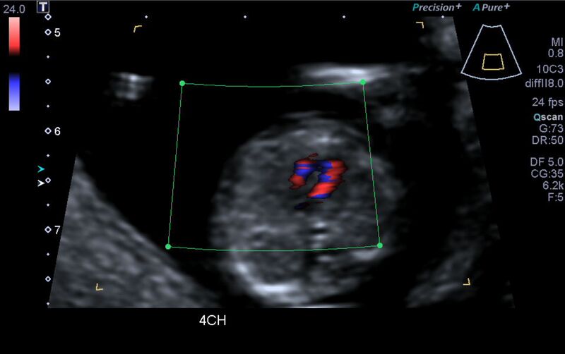File:1st trimester nuchal-morphology ultrasound (Radiopaedia 44706-48477 Heart views cine with colour 21).jpg