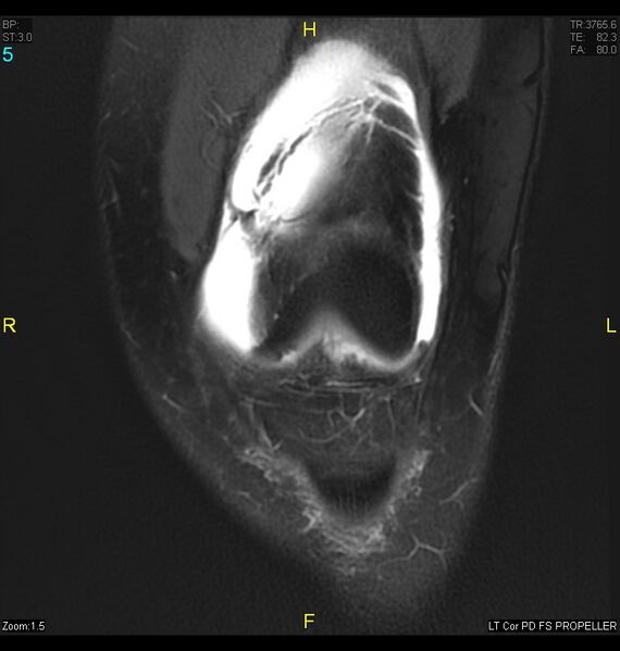 File:ACL mucoid degeration with cystic changes (Radiopaedia 48428-53341 Coronal PD fat sat 2).jpg