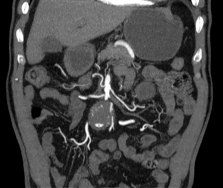 File:Abdominal aortic aneurysm (Radiopaedia 22421-22458 C 9).jpg