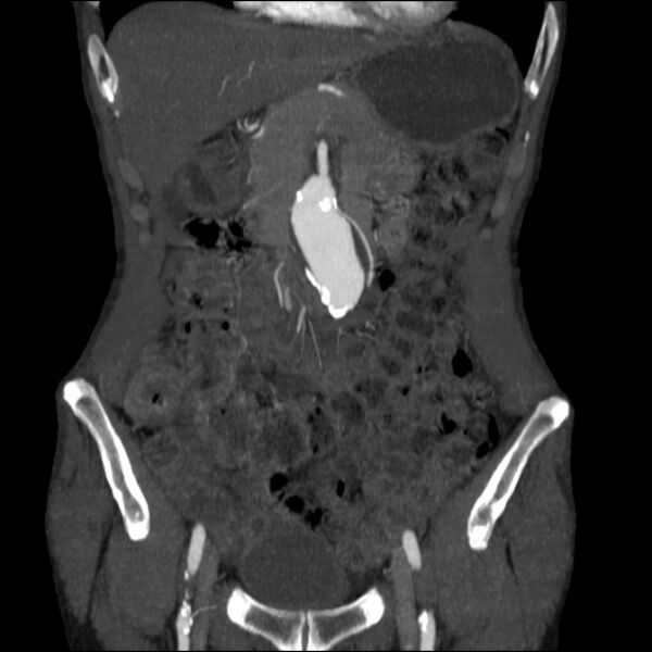 File:Abdominal aortic aneurysm (Radiopaedia 23703-23856 Coronal C+ arterial phase 6).jpg