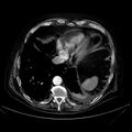 Abdominal aortic aneurysm (Radiopaedia 25855-26001 Axial C+ arterial phase 17).jpg