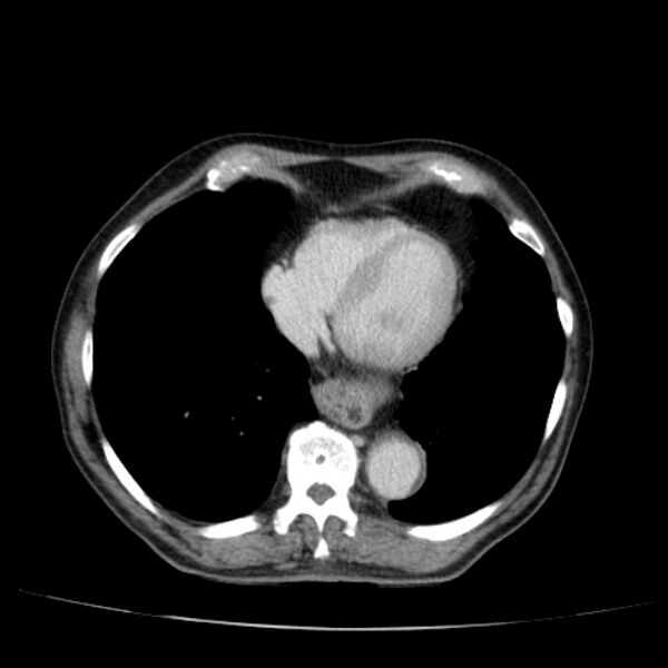 File:Abdominal aortic aneurysm (Radiopaedia 29248-29660 Axial C+ portal venous phase 5).jpg