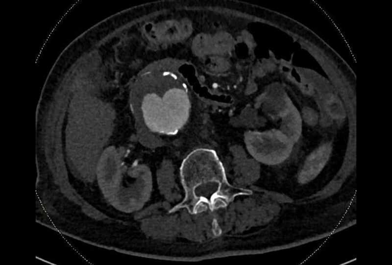 File:Abdominal aortic aneurysm with thrombus fissuration (Radiopaedia 73192-83919 Axial C+ arterial phase 79).jpg
