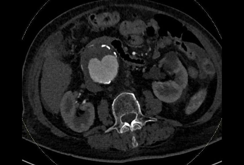 Abdominal aortic aneurysm with thrombus fissuration (Radiopaedia 73192-83919 Axial C+ arterial phase 79).jpg