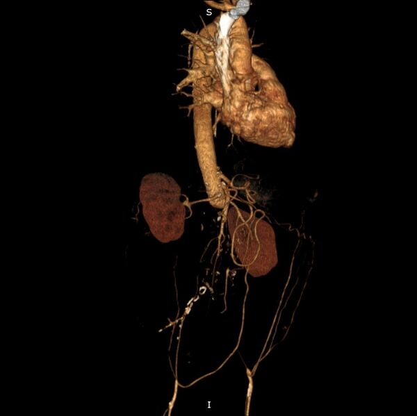 File:Abdominal aortic interposition tube graft and aneurysm thrombosis (Radiopaedia 71438-81857 3D VRT C+ arterial phase 15).jpg
