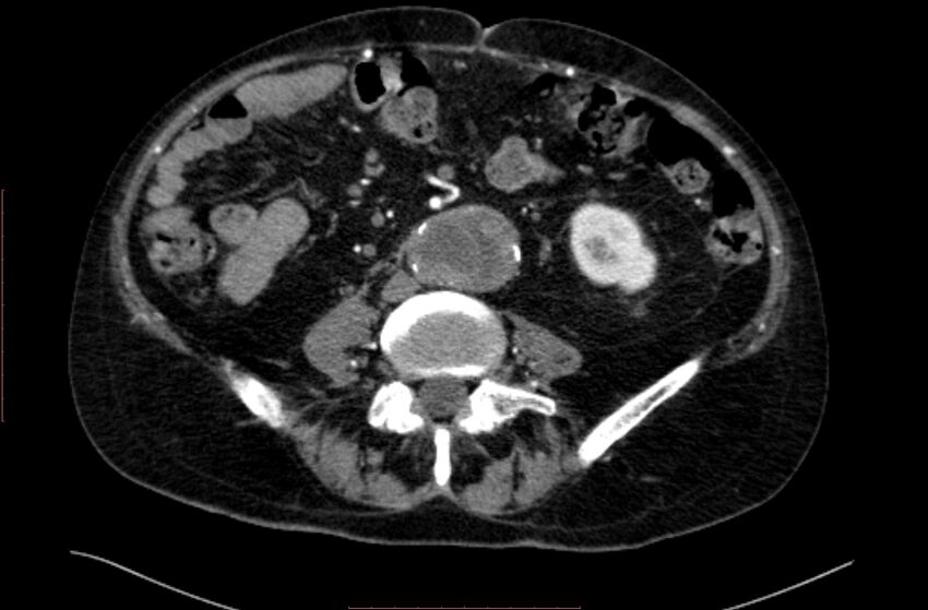 Abdominal aortic interposition tube graft and aneurysm thrombosis (Radiopaedia 71438-81857 Axial C+ arterial phase 112).jpg