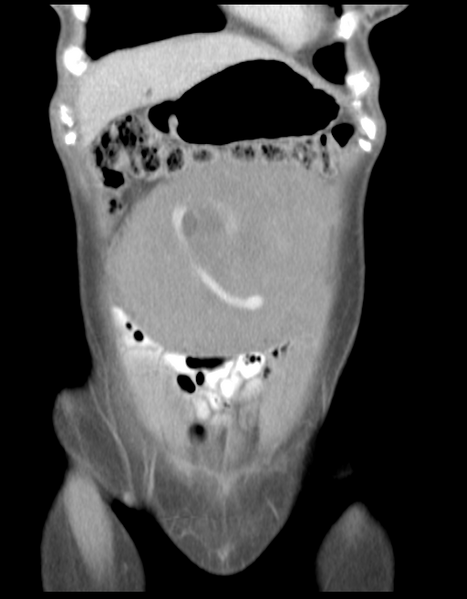 File:Abdominal desmoid tumor (Radiopaedia 41007-43740 Coronal C+ portal venous phase 9).png