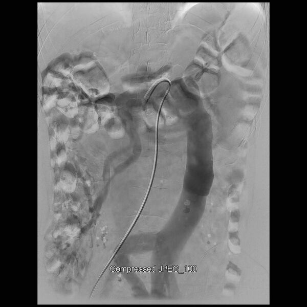 File:Abernethy malformation (Radiopaedia 42006-45462 Frontal Superior mesenteric artery 16).jpg