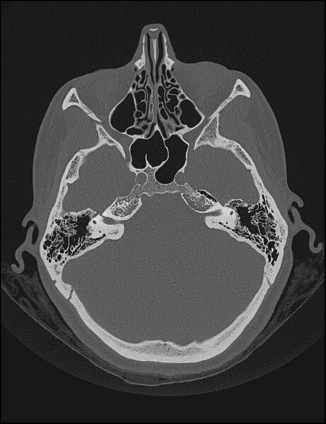 File:Aberrant right internal carotid artery (Radiopaedia 65191-74198 Axial non-contrast 50).jpg